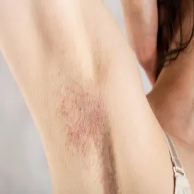 Krostki pod pachami zapalenie mieszków włosowych