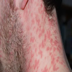 Krostkowa łuszczyca na szyi