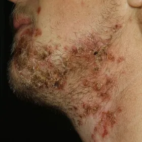 Krosty na brodzie liszajec