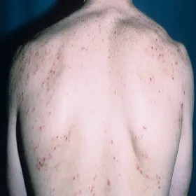 Krosty na plecach choroba Duhringa