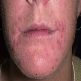 Krosty wokół ust zapalenie mieszków włosowych