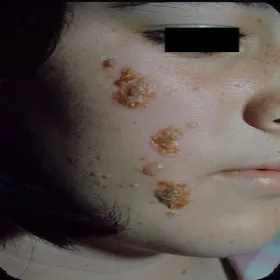 Krosty, grudki twarz liszajec