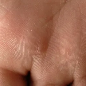 Kurzajka na wewnętrznej części dłoni