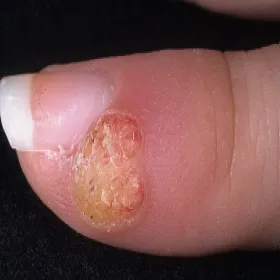 Kurzajka przy paznokciu