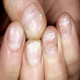 Leukonychia bielactwo paznokci