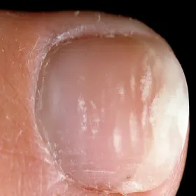 Leukonychia partialis