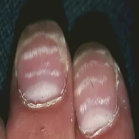 Leukonychia transversalis