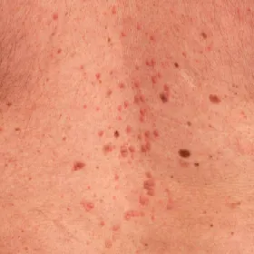 Liszaj czerwony płaski