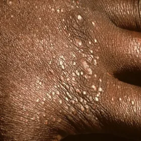 Liszaj lśniący choroba skórna