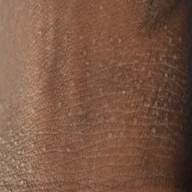 Liszaj lśniący choroba