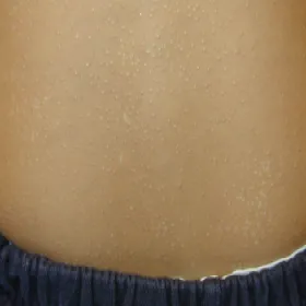 Liszaj lśniący na brzuchu u dziecka