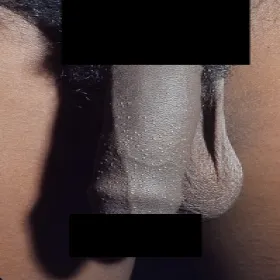 Liszaj lśniący na penisie