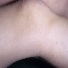 Liszaj lśniący u dzieci na nogach