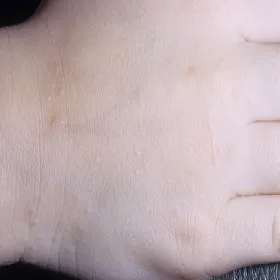 Liszaj lśniący u dziecka