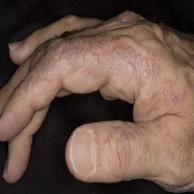 Liszaj płaski na dłoni