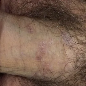 Liszaj płaski na narządach płciowych