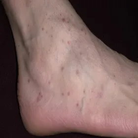 Liszaj płaski na stopie