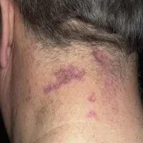 Liszaj płaski na szyi