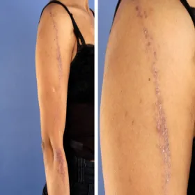 Liszaj płaski zdjęcie