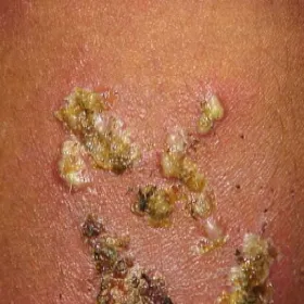 Liszajec pęcherzowy