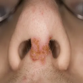 Liszajec pęcherzykowaty 