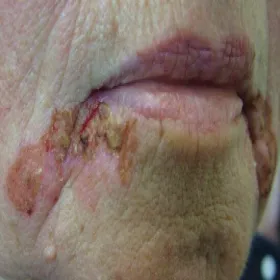 Liszajec u dorosłych 