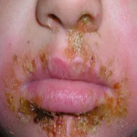 Liszajec wysypka koło ust