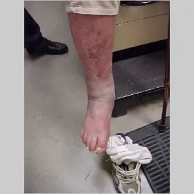 Lokalne zaczerwienienie powierzchni skóry wyprysk żylakowy