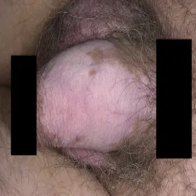 Mężczyzna choroba bielactwo