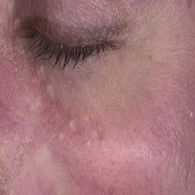 Małe białe grudki na twarzy syringoma