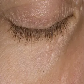 Małe, białe grudki syringoma