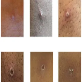 Małpia ospa wykwity skórne