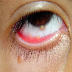 Mały guzek pod okiem żółtakoziarniniakowatość młodzieńcza 