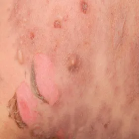 Martwica skóry po zażyciu leków