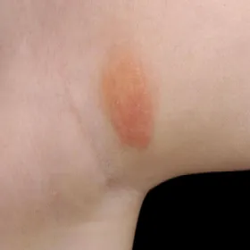 Mastocytoza na skórze zdjęcie