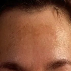 Melasma na czole