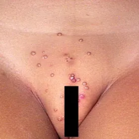 Mięczak zakaźny miejsc intymnych u dzieci