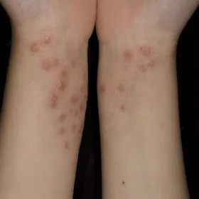 Mięczak zakaźny na nadgarstkach