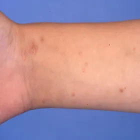 Mięczak zakaźny na ręce u dziecka