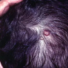 Mięczak zakaźny na skórze głowy