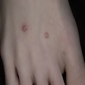 Mięczak zakaźny na stopie