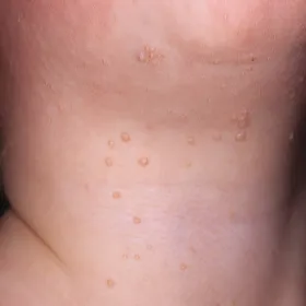 Mięczak zakaźny na szyi