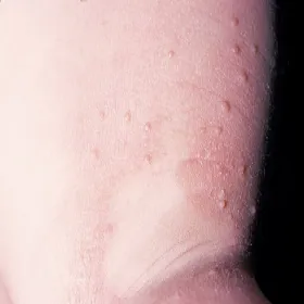 Mięczak zakaźny objawy