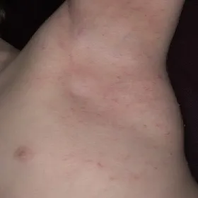 Mięczak zakaźny pod pachą