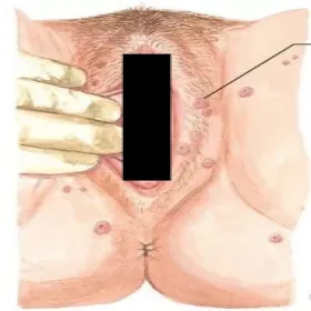 Mięczak zakaźny sromu