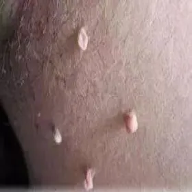 Miękki włókniak na skórze