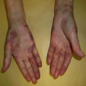 Mięsak Kaposiego na dłoniach