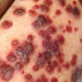 Mięsak Kaposiego na skórze