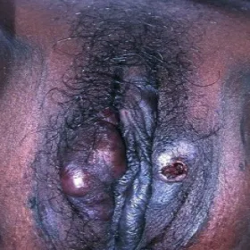 Mięsak Kaposiego na sromie