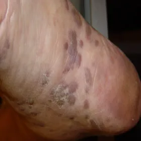 Mięsak Kaposiego na stopie